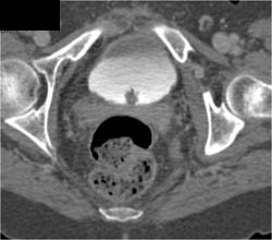 Bladder Cancer - CTisus CT Scan