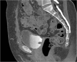 Bladder Cancer - CTisus CT Scan