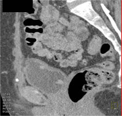 Bladder Cancer - CTisus CT Scan