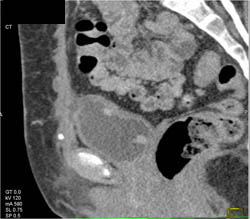 Bladder Cancer - CTisus CT Scan