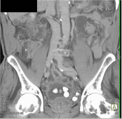 Bladder Calculi - CTisus CT Scan