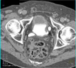 Greater Than 50% Stenosis of LAD - CTisus CT Scan