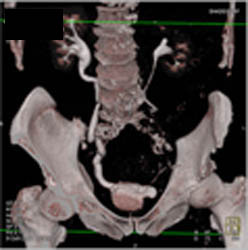 High -greater Than 500- Agatston Score - CTisus CT Scan