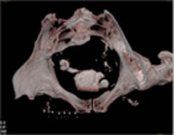 Significant Coronary Artery Disease - CTisus CT Scan