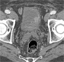 Coronary Artery Stent - CTisus CT Scan