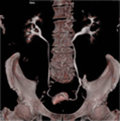 Coronary Artery Disease - CTisus CT Scan