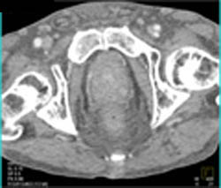 Saphenous Vein Graft Aneurysm - CTisus CT Scan