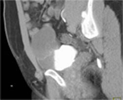 Normal Aortic Valve Replacement -closed/open - CTisus CT Scan