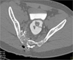 Open and Closed Aortic Valve - CTisus CT Scan