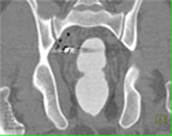 Dilated Aortic Sinus - CTisus CT Scan