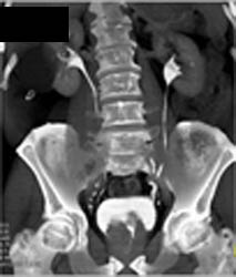 Clot in Left Atrium - CTisus CT Scan