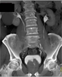 Dilated Coronary Sinus - CTisus CT Scan