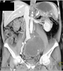 Stent in LAD - CTisus CT Scan