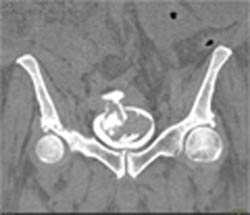 Coronary CTA - CTisus CT Scan