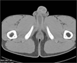 Normal Aortic Valve - CTisus CT Scan