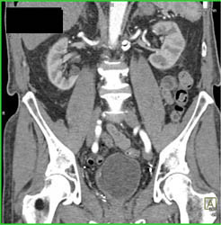 Normal Coronary Arteries - CTisus CT Scan