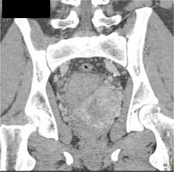 Normal CTA - CTisus CT Scan