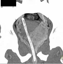 Normal Internal Mammary Arteries - CTisus CT Scan