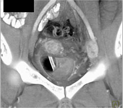 Arrhythmias Causing Motion on Aortic Valve - CTisus CT Scan