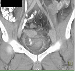 Dilated Aortic Valve - CTisus CT Scan