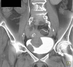 Contrast in Right Side of Heart - CTisus CT Scan