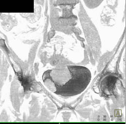 Nice View of Coronary Arteries - CTisus CT Scan