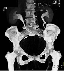 Calcified Aortic Valves - CTisus CT Scan