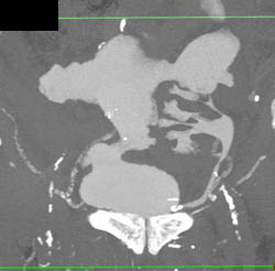 Diseased LAD - CTisus CT Scan