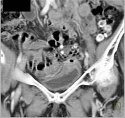 Normal Right Coronary Artery - CTisus CT Scan