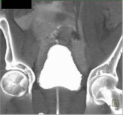 Aortic Valve Replacement (AVR) - CTisus CT Scan