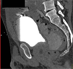 Coronary Vein - CTisus CT Scan