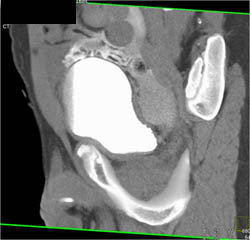 Calcified Plaque in Coronary Artery - CTisus CT Scan