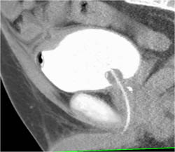 Coronary Artery Bypass Grafts - CTisus CT Scan