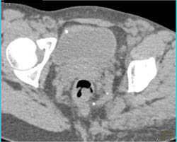 Normal Arch - CTisus CT Scan