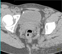 Normal Coronary Artery - CTisus CT Scan