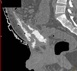 Perforated Bladder With Fistulae to Abdominal Wall - CTisus CT Scan