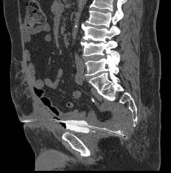 Supra-pubic Catheter Perforates the Bladder and Goes Into the Rectum - CTisus CT Scan