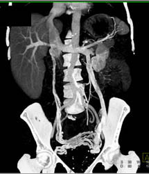 Pelvic Congestion Syndrome With Dilated Gonadal Veins - CTisus CT Scan