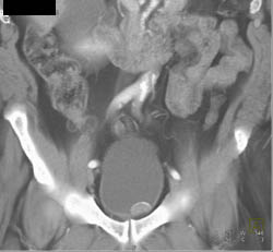 Bladder Cancer - CTisus CT Scan