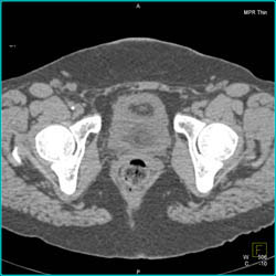 Bladder Cancer - CTisus CT Scan