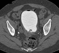 Bladder Cancer - CTisus CT Scan