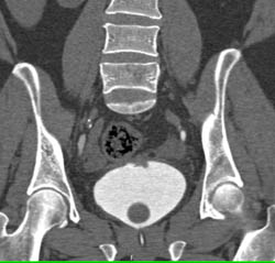 Bladder Cancer - CTisus CT Scan