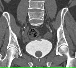 Bladder Cancer - CTisus CT Scan