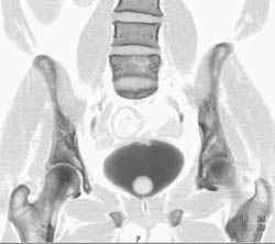 Bladder Cancer - CTisus CT Scan