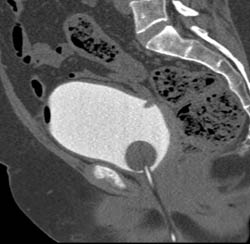 Bladder Cancer - CTisus CT Scan