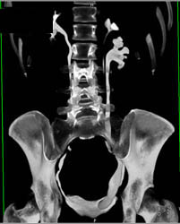 Duplicated Left Collecting System With Ectopic Ureterocele - CTisus CT Scan