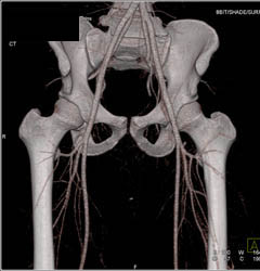 CTA Pelvis Without Bleed - CTisus CT Scan