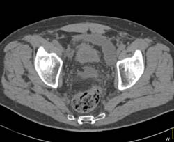 S/P Prostatectomy With Leak From Bladder on CT Cystogram- See Sequence - CTisus CT Scan