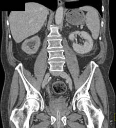 Bladder Cancer With Right Hydronephrosis - CTisus CT Scan