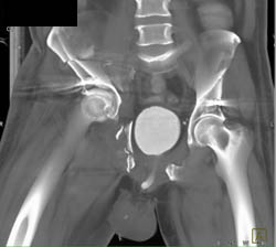 Pelvic Fracture With Normal CT Cystogram - CTisus CT Scan